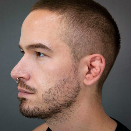 Cauliflower Ears