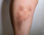 Bruises 3C
