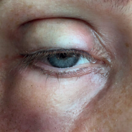 SB4 Geschwollenes Auge (rechts)