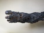 Burned Foot