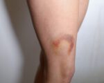 Bruises C - Final Stages Bruises Set