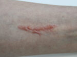 SS11 Kleine Narbe