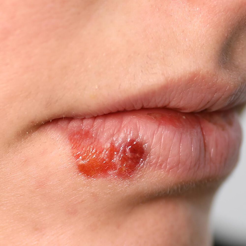 Skin Disease
