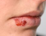 Skin Disease