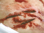 SW1 Stichwunde