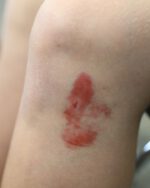 Bruises 1 Set