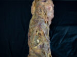 Rotten Leg