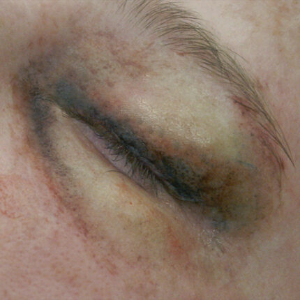 SB1 Geschwollenes Auge (links)