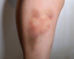 Bruises 3 Set