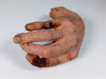 Walda - Infizierte rechte Hand BACKGROUND