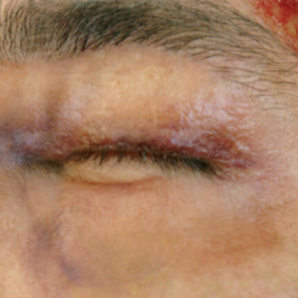 SB2 Geschwollenes Auge (links)