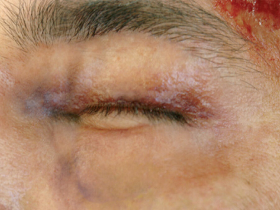 SB2 Geschwollenes Auge (links) SB2 Geschwollenes Auge (links)