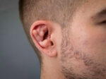 Cauliflower Ears
