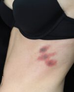 Bruises 2 Set