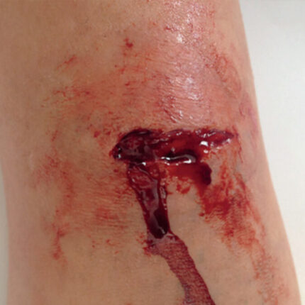 SW8 Stichwunde
